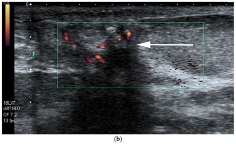 Cancers | Free Full-Text | Retroareolar Carcinomas in Breast Ultrasound ...