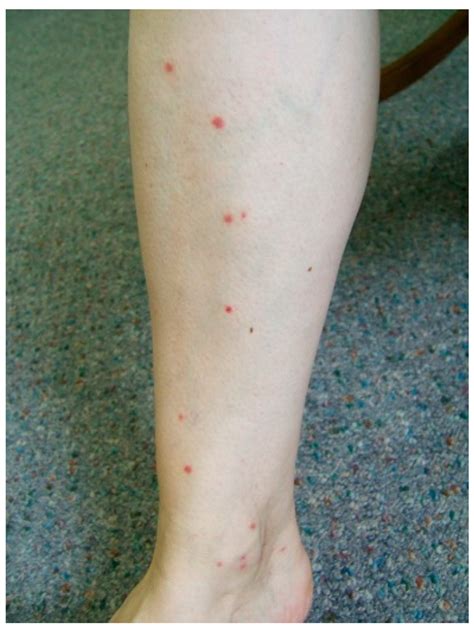 A few red papules on the lower limb of a 54-year-old woman after the... | Download Scientific ...