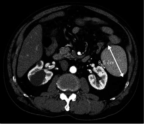 CT scan showing 8.5 cm sized accessory spleen in the left upper ...