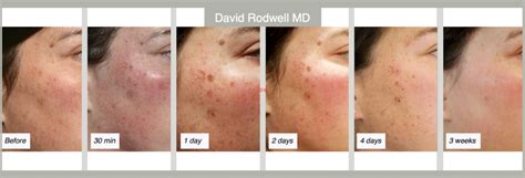 IPL Laser Treatment Charleston | Dr. David Rodwell