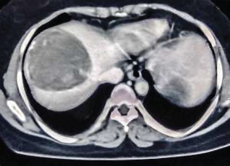 CT scan of abdomen showing giant lobulated hydatid cyst in the right... | Download Scientific ...