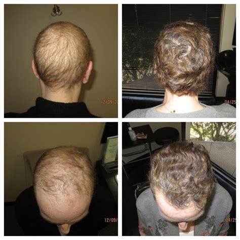 Natural Solution For Hair Growth After Chemo | TM Hair