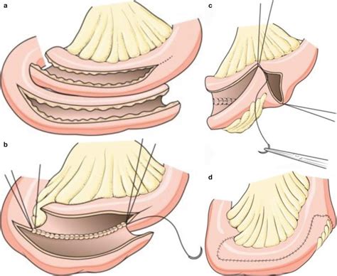 Surgery in Inflammatory Bowel Diseases | Basicmedical Key