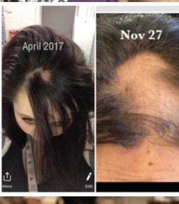 Monat hair loss - how it started, and how it ended up. It’s grown back now, but took almost 3 ...