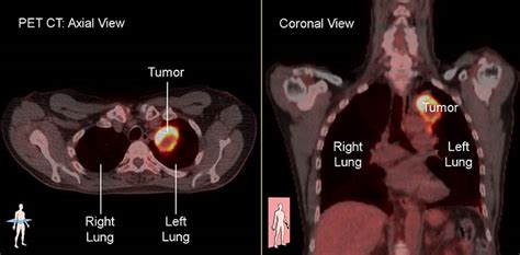 Imaging Tests | LUNGevity Foundation