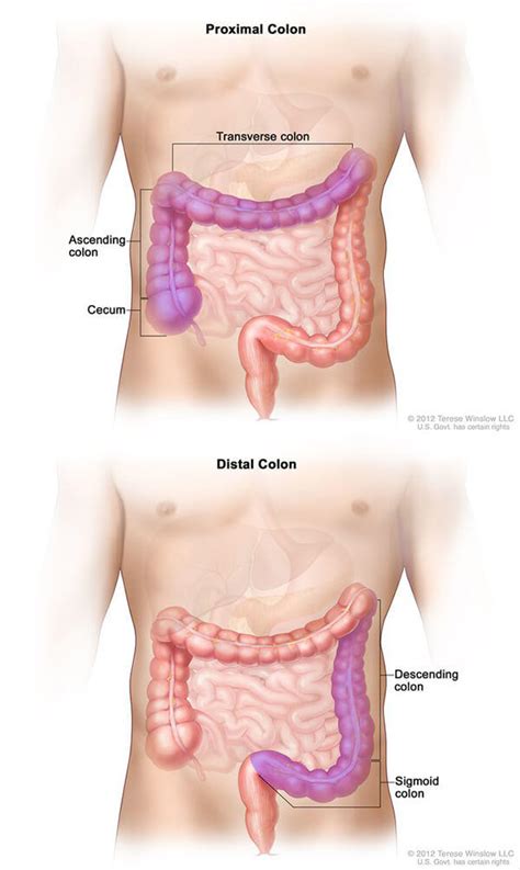 Colorectal Cancer Survival Linked to Tumor Location - NCI