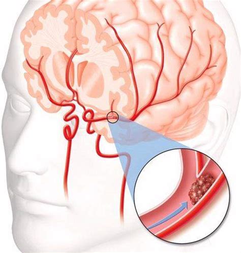 What do You Mean by Blood Clot Brain Surgery