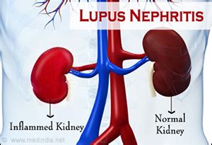 Ayurvedic Treatment for Lupus Nephritis - Causes, Symptoms, Stages, Diagnosis, Herbal Remedies ...