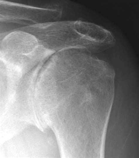 UW Shoulder and Elbow Academy: Rheumatoid arthritis of the shoulder, x-ray appearance