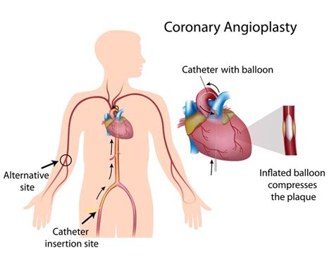 Coronary Intervention - Angioplasty and Stent Placement | Cardiovascular Consultants of South ...