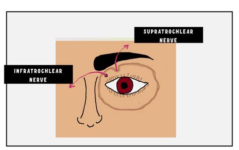 Nerve Blocks for Lacrimal Sac Surgeries: A Comprehensive Guide - INSIGHT OPHTHALMOLOGY