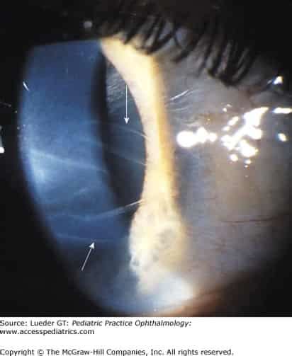 Cloudy Cornea Diagnosis | AccessMedicine Network