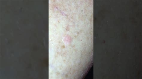 Bumps like this started appearing on my leg always below the knee - YouTube