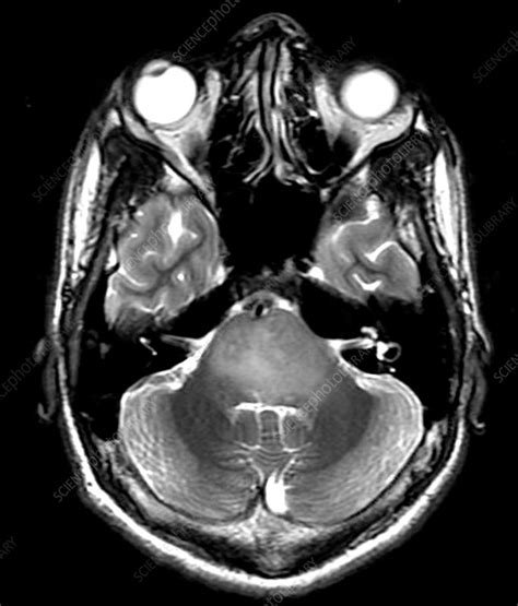 Brainstem Glioma in Child (MRI) - Stock Image - C027/0895 - Science Photo Library