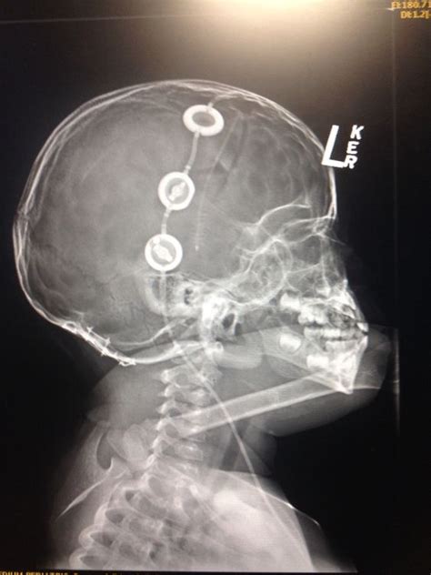 HYDROCEPHALUS TREATMENT | Buyxraysonline