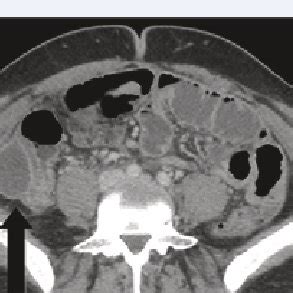 CT scan right iliac fossa collection. | Download Scientific Diagram