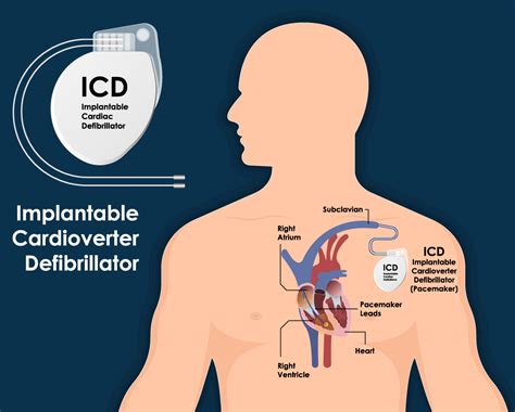 Defibrillators | Heart Rhythm Consultants