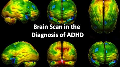 Brain Scan in the Diagnosis of ADHD - YouTube