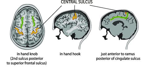 Sagittal Sulcus