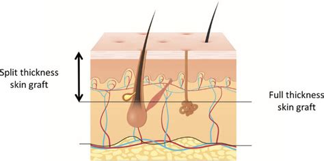 Split-thickness skin graft, full-thickness skin graft (↔) | Download Scientific Diagram