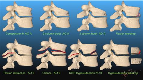 Spine Fracture Classification- 2019 | UW Emergency Radiology