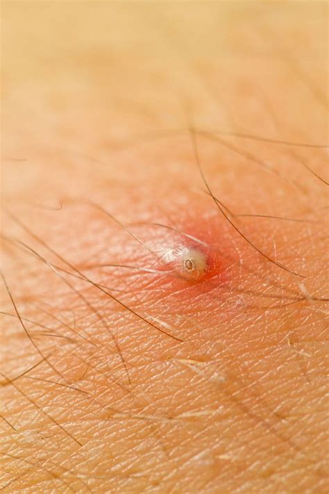 Five types of spot you should never squeeze or pick - and the two you ...