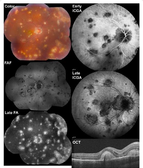 Multimodal imaging of a 29 year-old woman with multifocal choroiditis... | Download Scientific ...