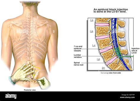 Level Left-side Lumbar Transforaminal Epidural Injection, 41% OFF