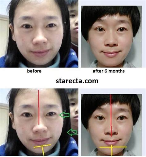 Asymmetrical Face Exercises