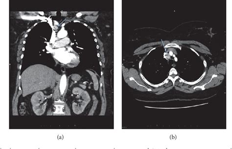 Figure 1 from Ectopic Thyroid Tissue in the Mediastinum Characterized by Histology and ...