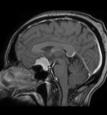 Tuberculum sellae meningioma | Radiology Case | Radiopaedia.org