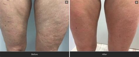 Leg Cellulite Before & After Velashape III – From Orange Peel to Silky ...