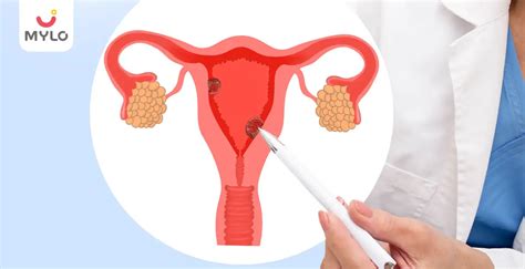 Endometrial Hyperplasia: Understanding Its Causes and Treatment | MyloFamily