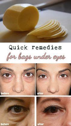 Quick Way To Reduce Puffy Eyes - Just For Guide