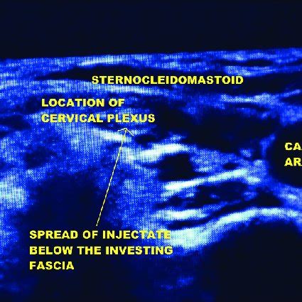 Ultrasound guided intermediate cervical plexus block showing spread of ...