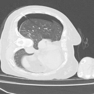 Images of lung CT scan for the development of pneumothorax. A... | Download Scientific Diagram