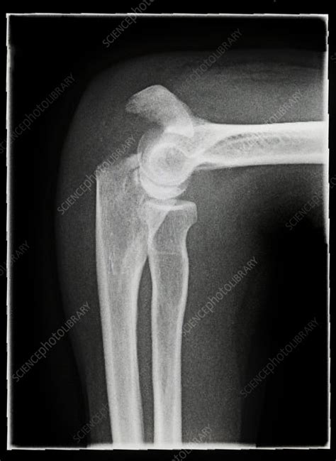 Broken elbow, X-ray - Stock Image - C014/7724 - Science Photo Library