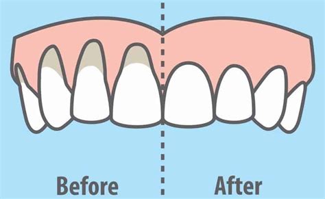 Truth About Gum Recession Causes | Newton Drive Family Dentistry | Covington, GA