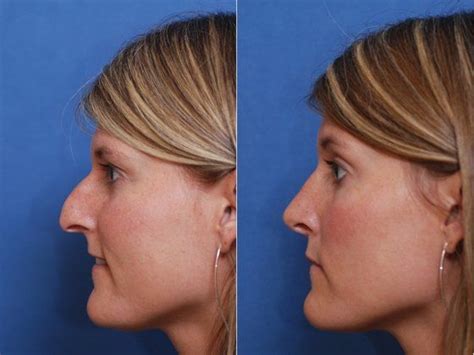 Rhinoplasty for Polly Beak By Dr Sherris in Buffalo - Rhinoplasty ...