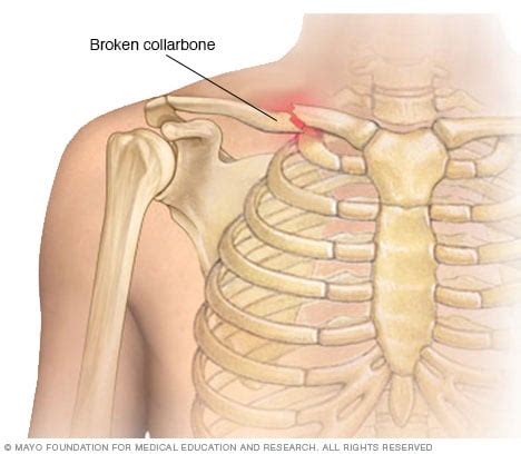 Broken collarbone - Symptoms and causes - Mayo Clinic