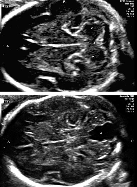 Cerebellar Hypoplasia Ultrasound