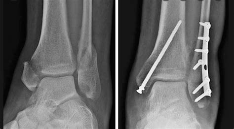 Bimalleolar ankle fracture surgery - enstat