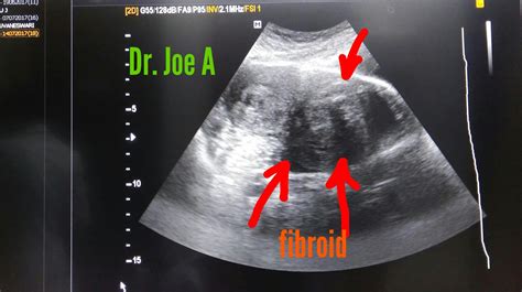 Ultrasound imaging: Cervical fibroid- a large one