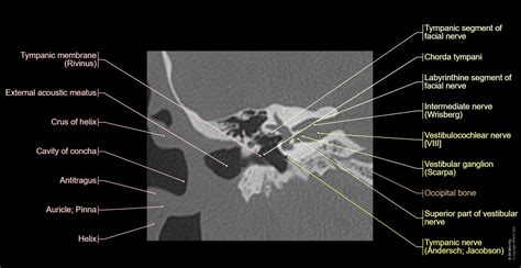 Petrous bone CT: normal anatomy | e-Anatomy