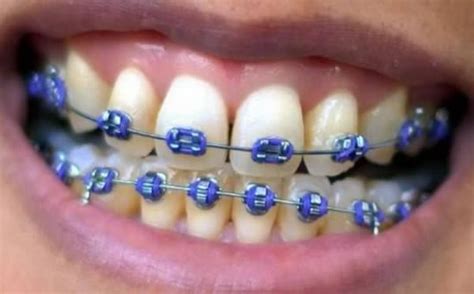 22 best images about Fake Braces on Pinterest | How to make, Gwen stefani and Ugly betty