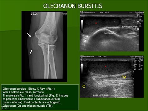 Olecranon Anatomy