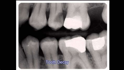 What Causes Tooth Decay? - Los Angeles Cosmetic Dentist