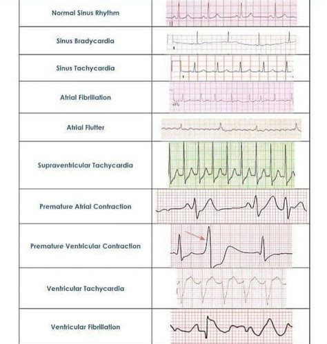 Medical Doctors on Instagram: “Normal sinus rhythm vs. abnormal rhythm ...