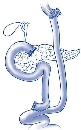 Total Gastrectomy For Stomach Cancer