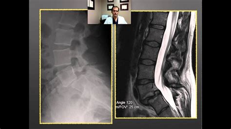 Dr. Ponce's clinic talk on pars defects - YouTube